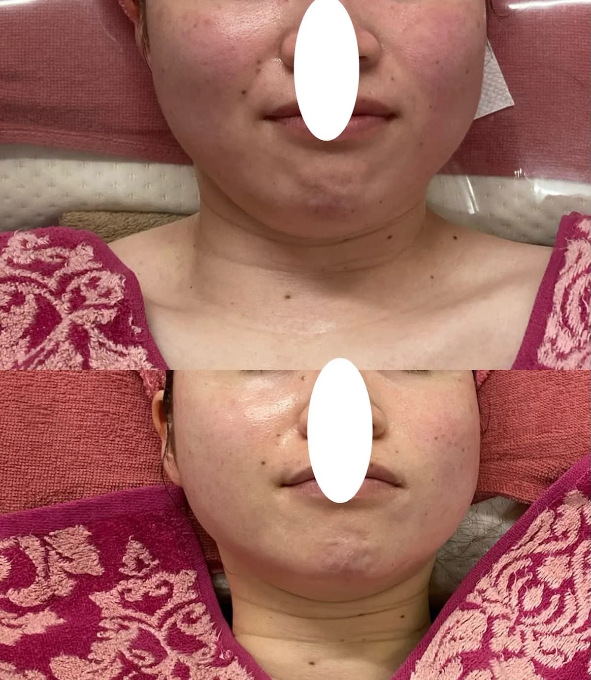 自然美人を叶える小顔とニキビのサロン